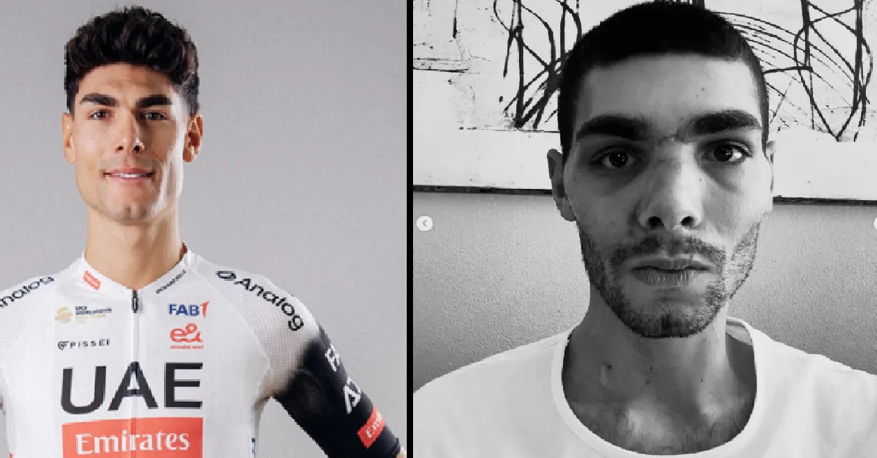 Italijanski biciklist podvrgnut operaciji rekonstrukcije lica nakon stravičnog pada